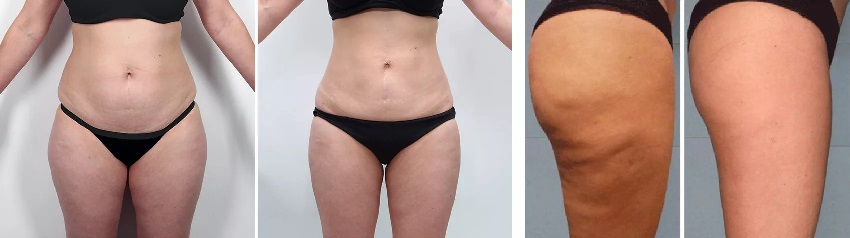 LPG массаж тела на аппарате Beautyliner-2.jpg