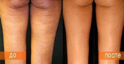 Механическая дермотония тела.jpg