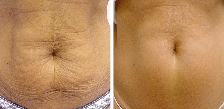 RF-лифтинг тела.jpg